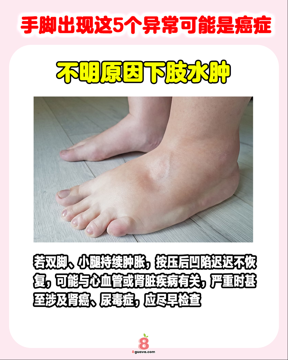 手脚出现这5个异常可能是癌症