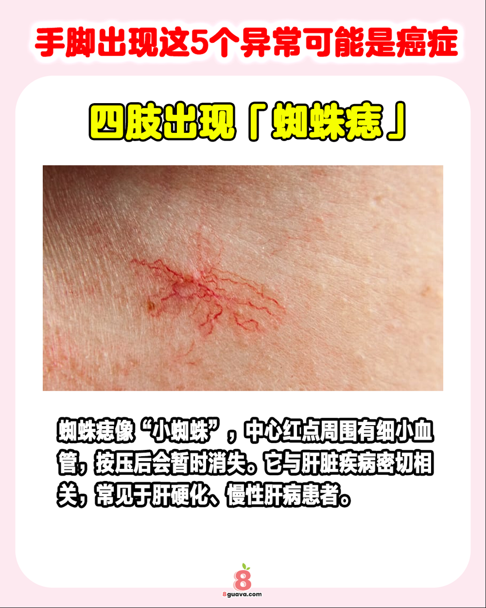 Image from: 手脚出现这5个异常可能是癌症 ❗🦠快@你的家人朋友一起来看❗
