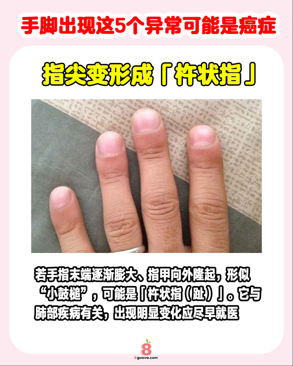 手脚出现这5个异常可能是癌症