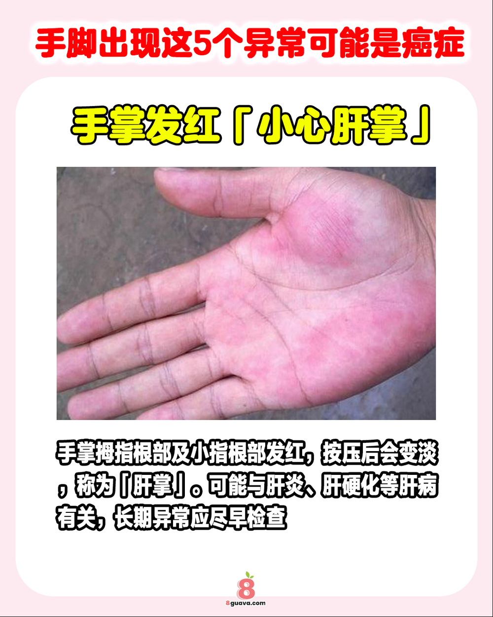 手脚出现这5个异常可能是癌症