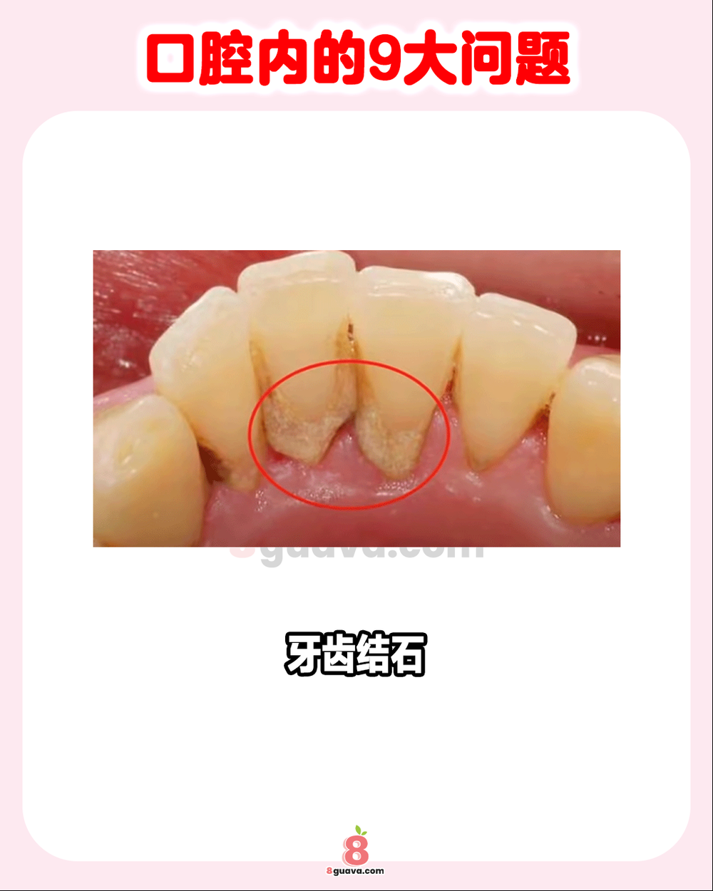 口腔内的9大问题