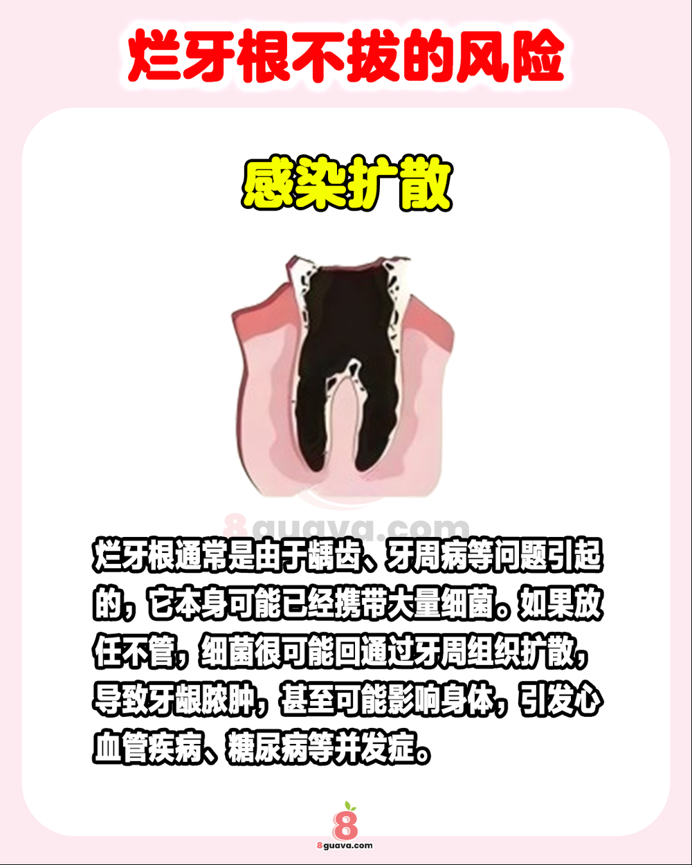 Image from: 烂牙根不拔的风险 一次看🦷这些情况下必须要拔❗