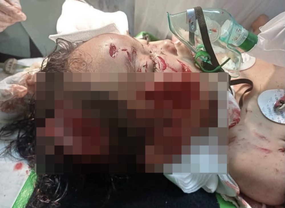Image from: Diserang Lima Anjing Liar, Kanak-Kanak Parah Selamat Jalani Pembedahan – “Adik Sangat Lemah, Nafasnya Perlahan..”