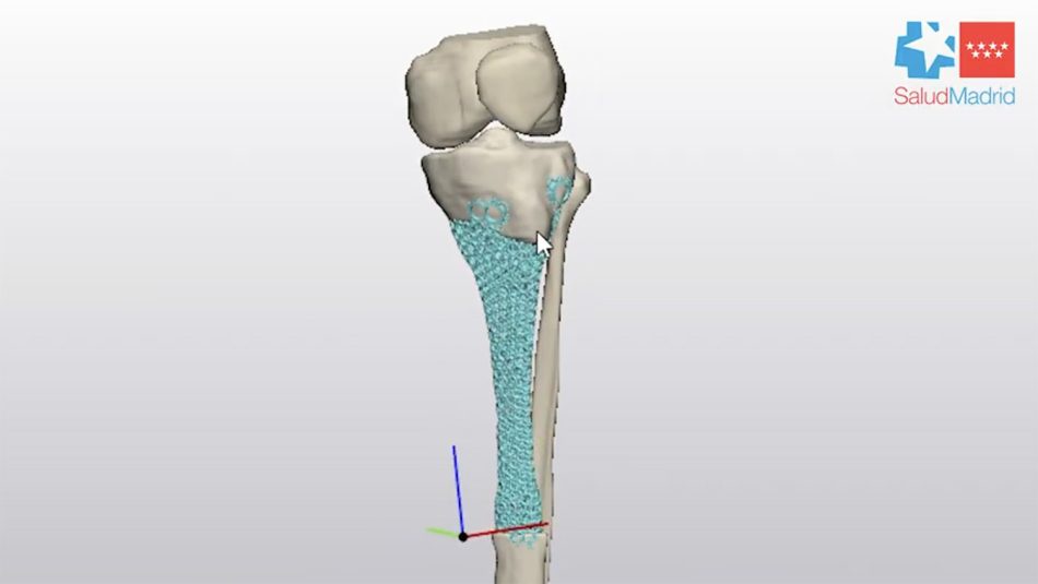 Image from: Teknik Cetakan 3D Titanium Mengelakkan Kaki Pesakit Kanser Tulang Dipotong