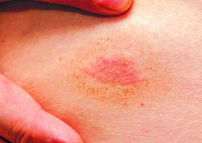 The ringworm myth