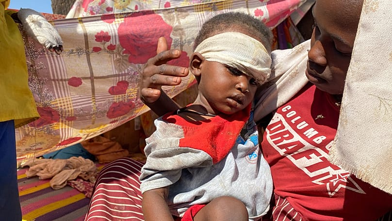 FILE - A Sudanese child, who fled Fasher with family after Sudan's paramilitary forces attacked the Darfur region, receives treatment at a camp in Tawila, Sudan, Nov. 2, 2025