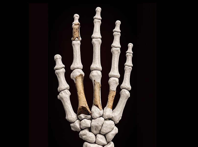 Reconstruction of the hand incorporating the original bones