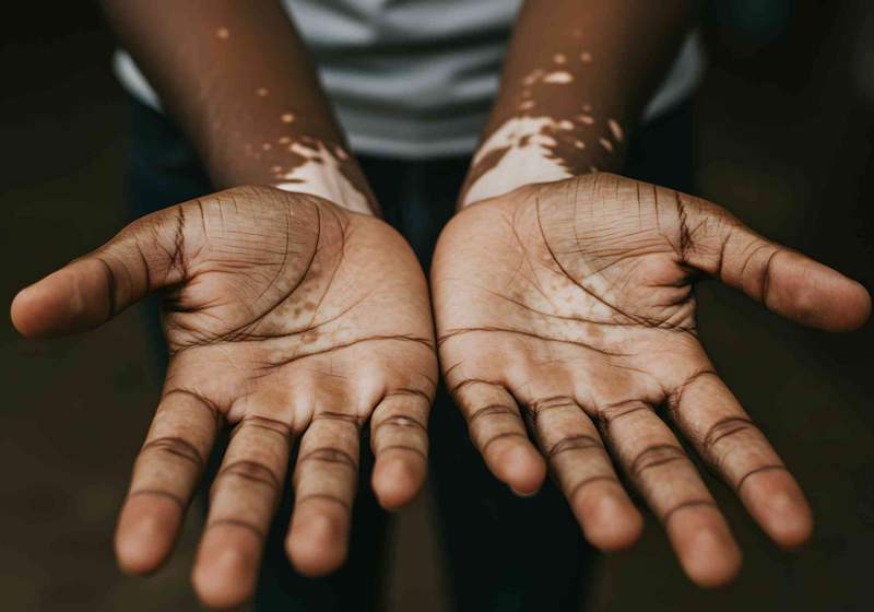 Image from: Vitiligo affects around 1 in 100 people worldwide – yet the skin condition remains misunderstood