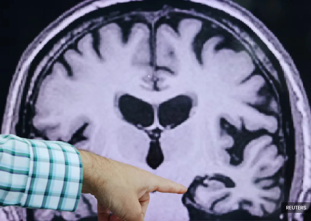 Image from: Alzheimer’s is more than forgetfulness as families also face major changes