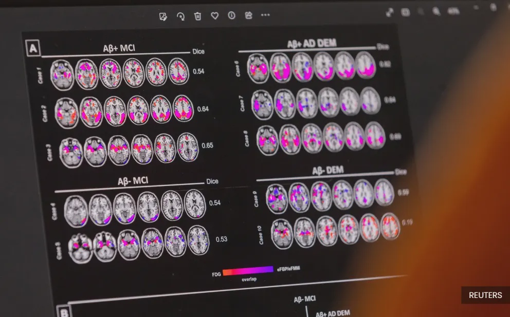 Image from: Alzheimer’s is more than forgetfulness as families also face major changes