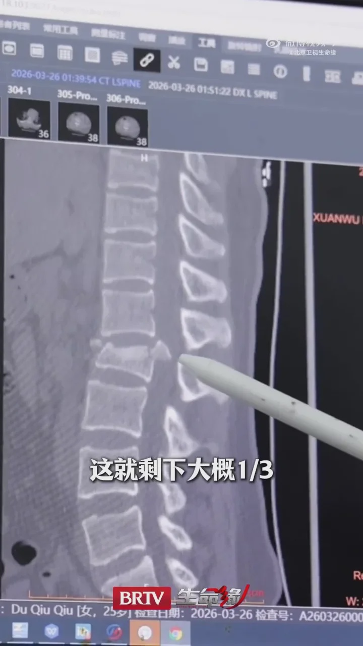 女子走楼梯看手机踩空摔倒下肢瘫痪康复中 4