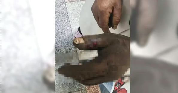 Image from: Panik Suami Dipatuk Ular Tedung, Wanita Sedut Bisa Sebelum Turut Keracunan