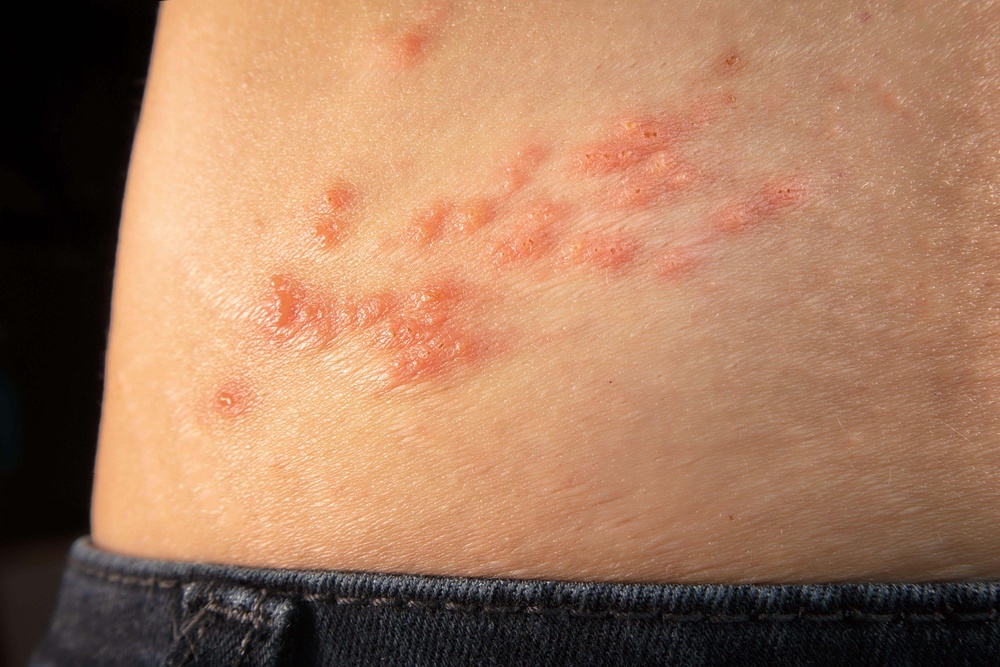 A study has found the current NHS vaccine for shingles slashes the risk of dementia by 17 per cent (Alamy/PA)