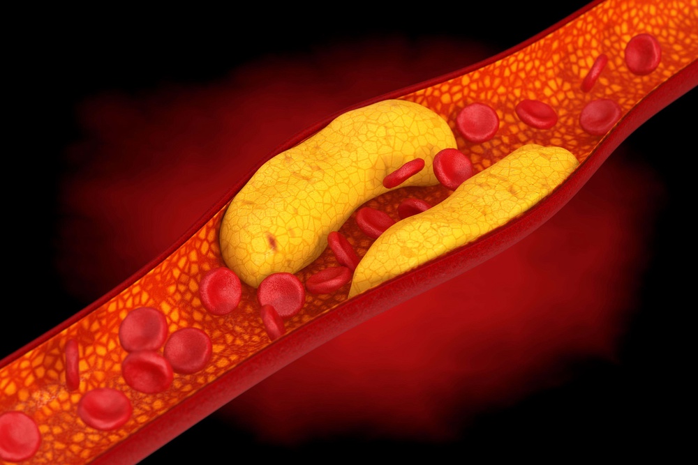 An artery blocked with cholesterol (Alamy/PA)