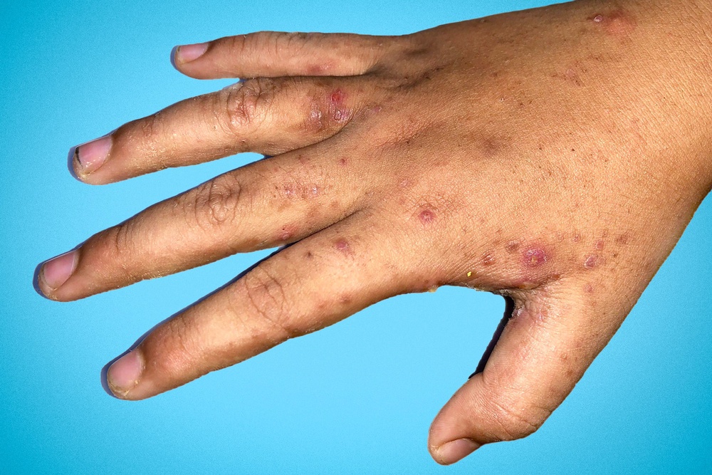 GPs report rise in scabies cases as public warned not to ignore