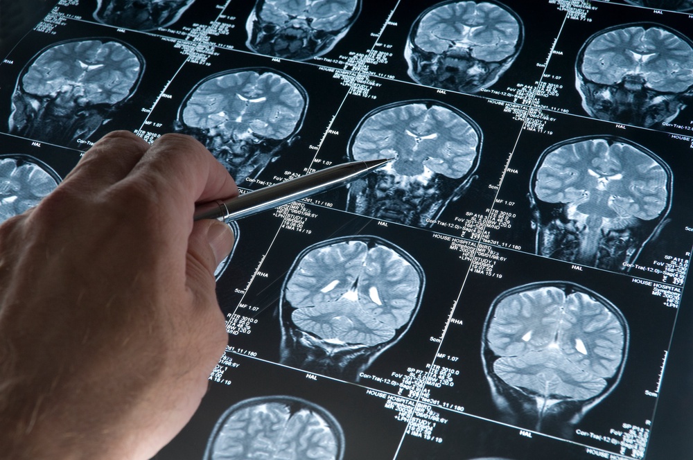 Alzheimer’s disease sees an abnormal buildup of tau in the brain, which affects memory, thinking skills and other mental abilities. (Getty/iStock)