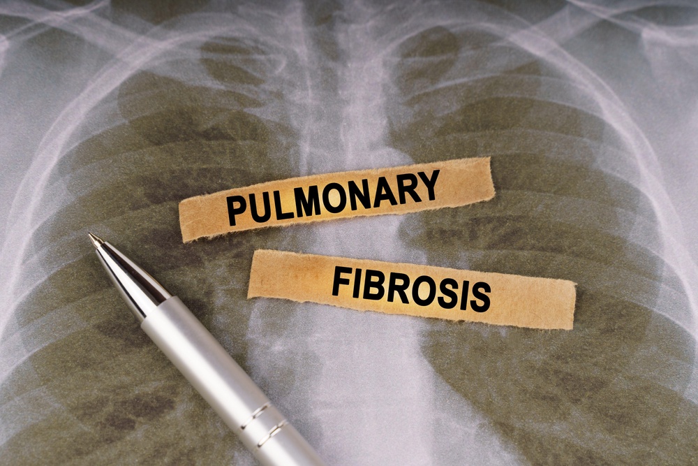 Any scarring that’s already in your lungs cannot be reversed (PA)