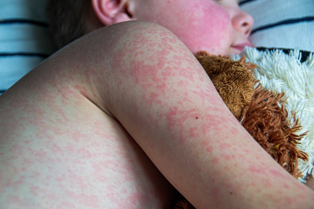 The measles rash looks brown or red on white skin, but may be harder to see on darker skin (Getty/iStock)