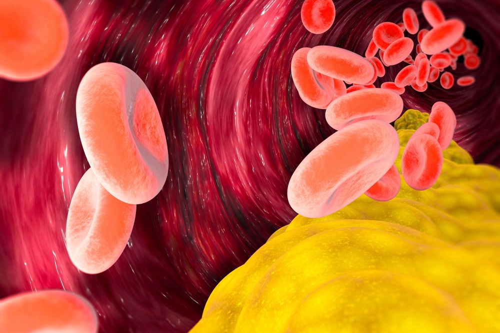 LDL (Low-density lipoprotein) can cause plaque to build in arteries (Alamy/ PA)