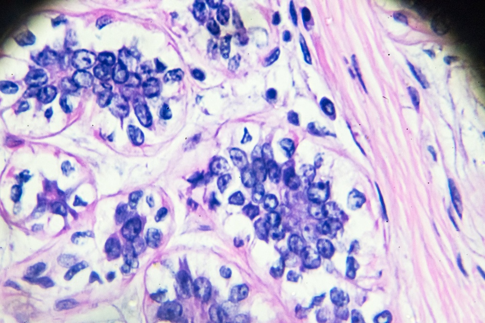 Scientists confirmed their findings in aggressive cancers such as breast cancer (Getty/iStock)