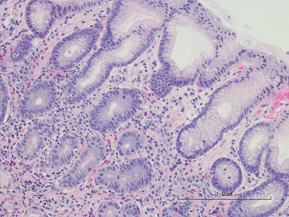 Helicobacter pylori infections were responsible for the greatest number of cancer cases in 2024 (Getty/iStock)