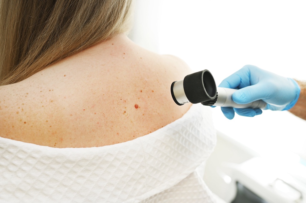 A dermatologist examines moles and skin growths on a patient's body using a special device (Getty/iStock)