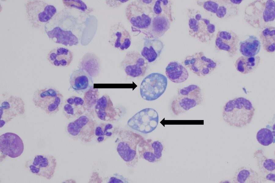 Naegleria fowleri, also known as a brain-eating amoeba, is almost always fatal, with a 98 percent fatality rate, according to the study (CDC/Dr. James Roberts, Children’s Healthcare of Atlanta)