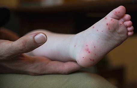 Hand, foot and mouth disease is more common in small children (CDC)