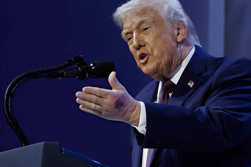 A bruise was seen on the back of Trump’s hand at Davos earlier this year (Getty)
