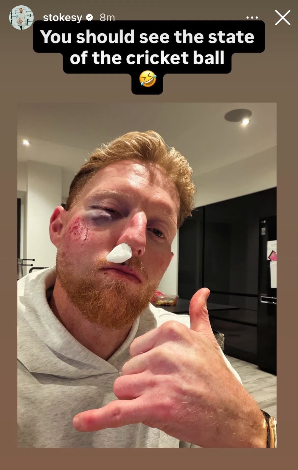 Stokes needed surgery after taking a ball to the face (Instagram)