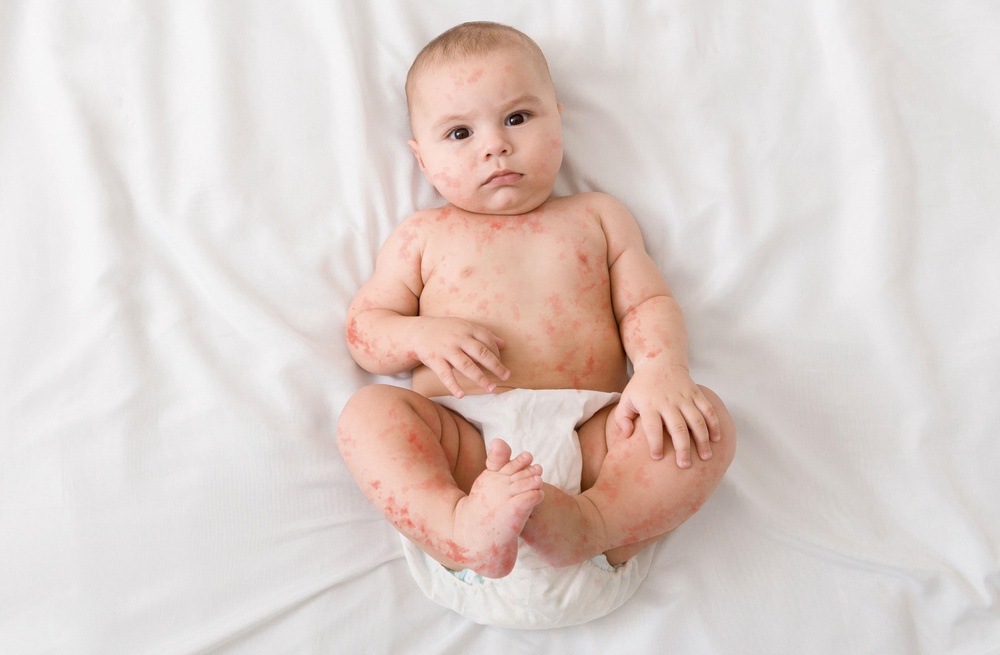 Measles is associated with a blotchy rash. (Alamy/PA)