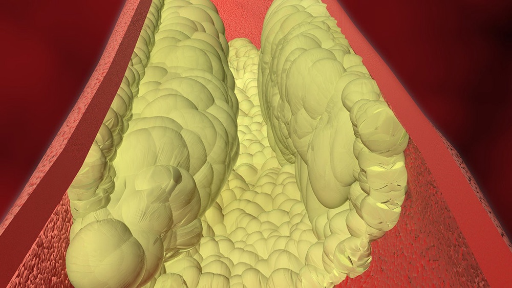 Plaque caused by high levels of the waxy substance known as cholesterol is seen filling and narrowing an artery in this graphic image from the U.S. Centers for Disease Control and Prevention. Blockages from this plaque can lead to a higher risk of heart attacks and stroke (CDC)