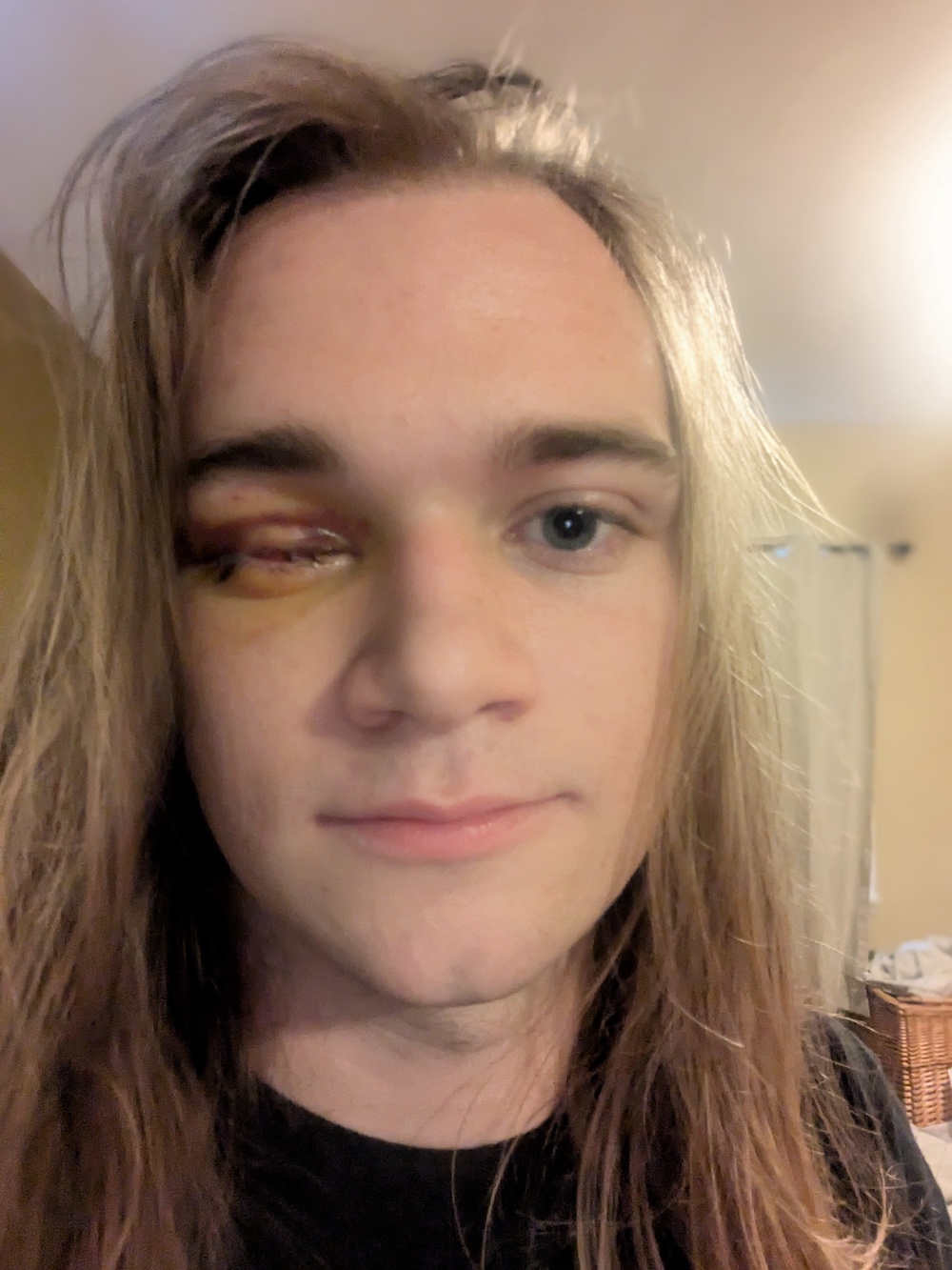 Collins says he was merely filming demonstrations when DHS agents fired less-lethal munitions into the crowd, immediately striking his face. The injury required surgical removal of his right eye (Courtesy Tucker Collins)