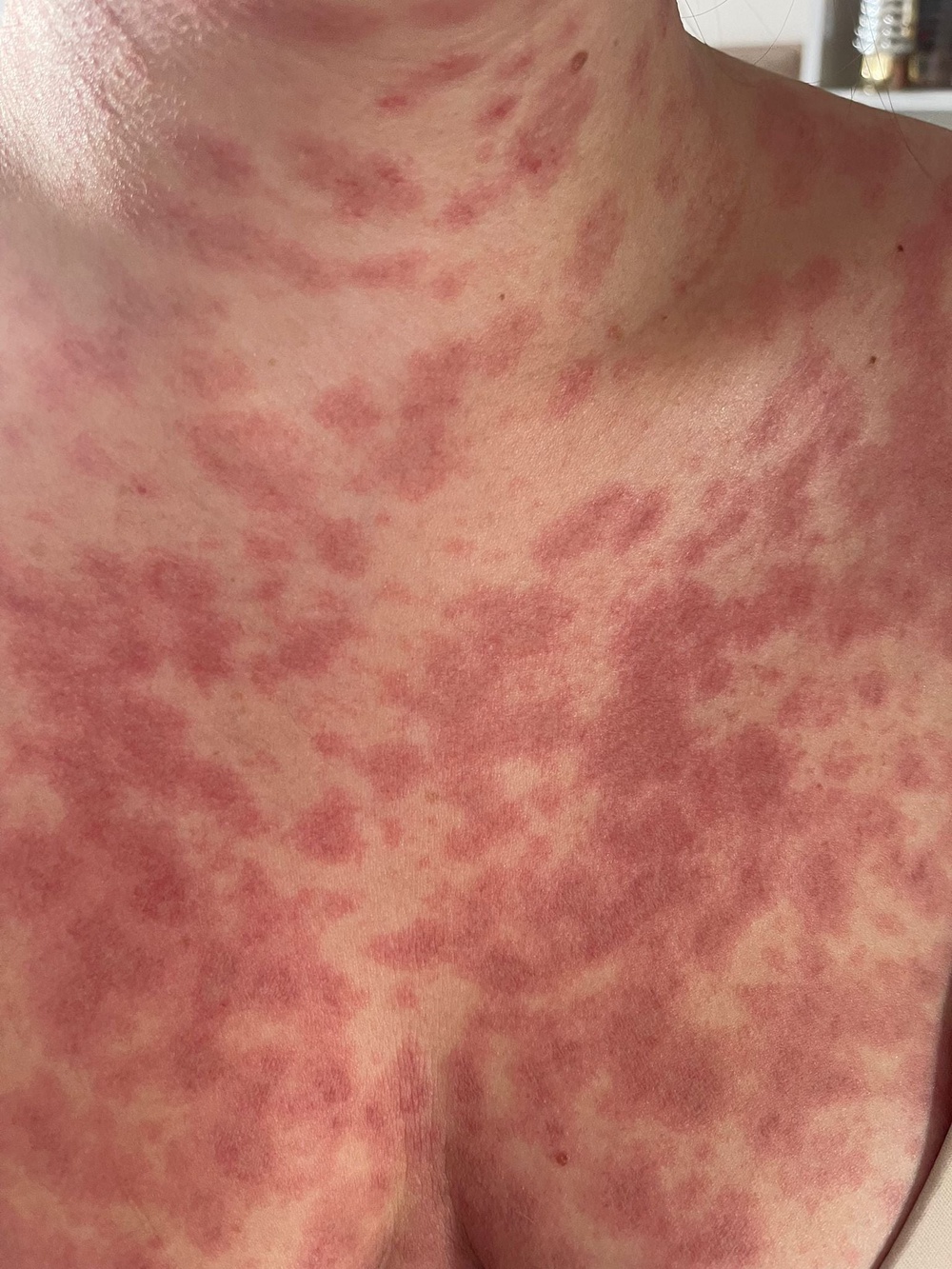 Meningitis symptoms can include blotchy or mottled skin. (PA)