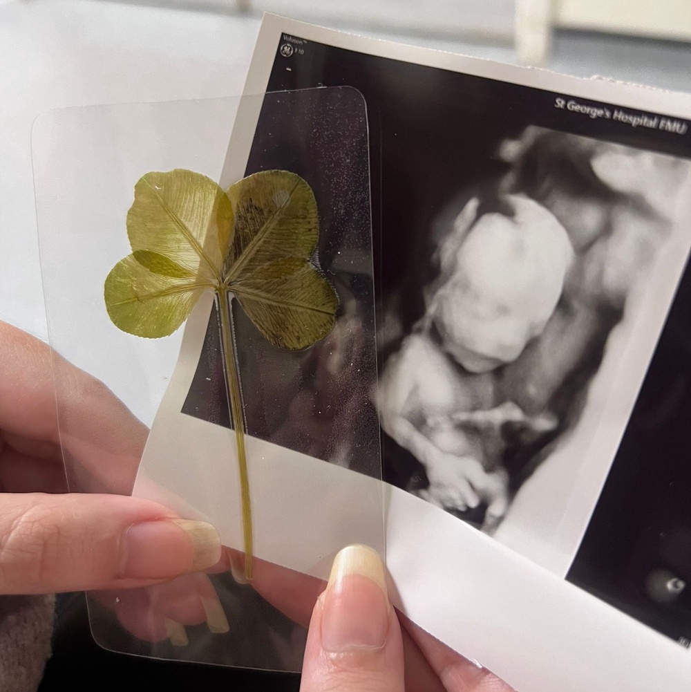 Doctors delivered a tiny transplant through an intricate procedure to Arthur when he was around the size of an avocado (NHSBT/PA) (PA Media)