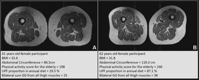 Thigh MRI scans of a 61-year-old woman, A, and a 62-year-old woman, B, show the impact of ultraprocessed foods. The 62-year-old’s diet was 87 percent ultraprocessed and the 61-year-old’s was just under 30 percent (Radiological Society of North America)