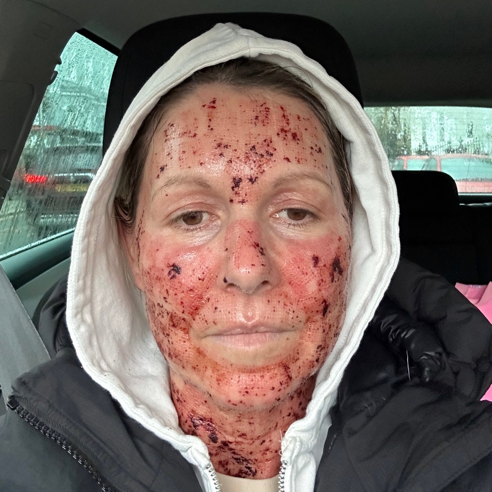 How I looked at school pick up straight after the procedure, but it was only dried blood (The Independent)
