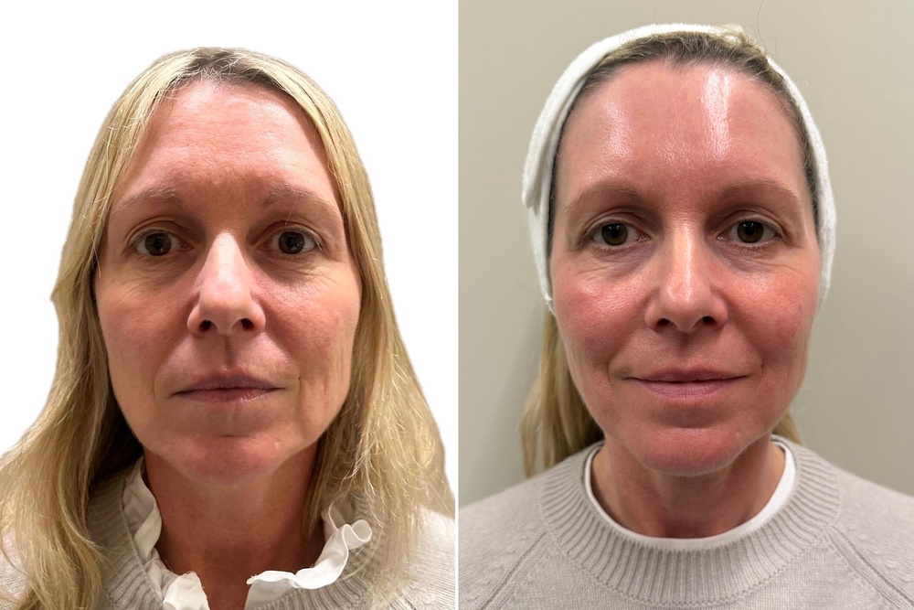 Before and after: Prior to the treatment in February – and then two months later (The Independent)