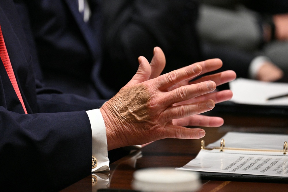 The president’s frequently bruised and makeup-covered hands, as well as his habit of appearing to fall asleep during public appearances, has prompted speculation about his health (AFP/Getty)