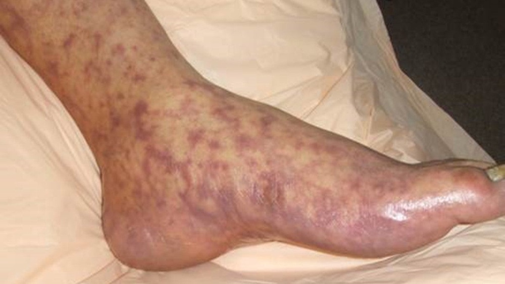 A splotchy red rash from a Rocky Mountain Spotted Fever infection is seen in this photo provided by the U.S. Centers for Disease Control and Prevention (CDC)