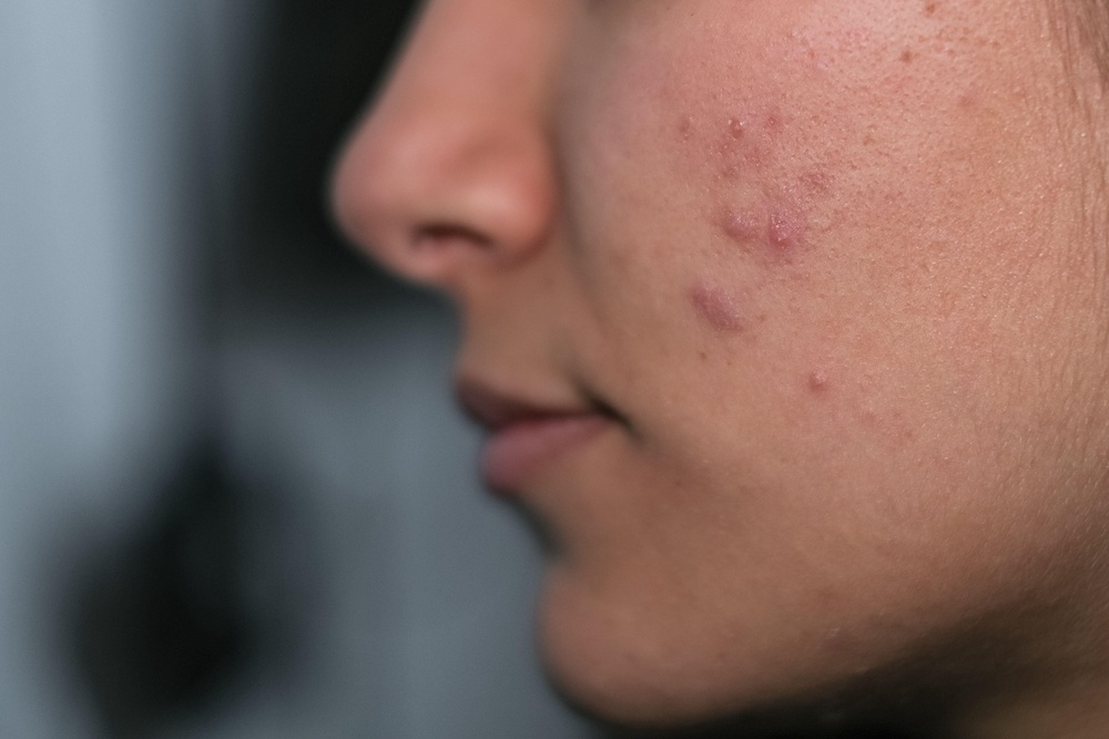 Close up picture of acne on a young woman’s face (Alamy/PA)