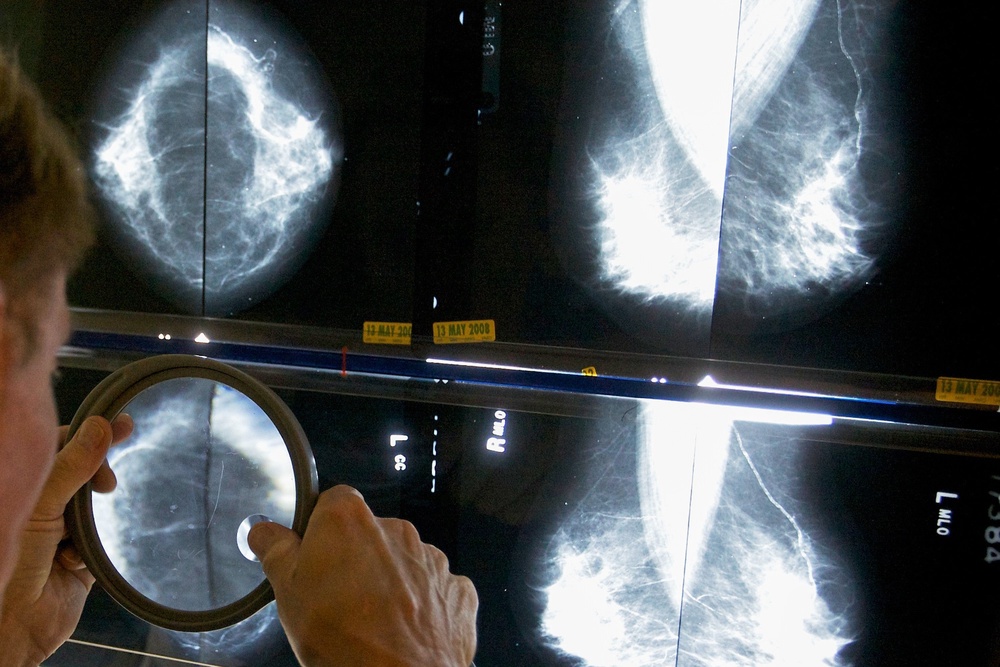 A radiologist uses a magnifying glass to examine mammograms for breast cancer in Los Angeles (Copyright 2019 The Associated Press. All rights reserved.)