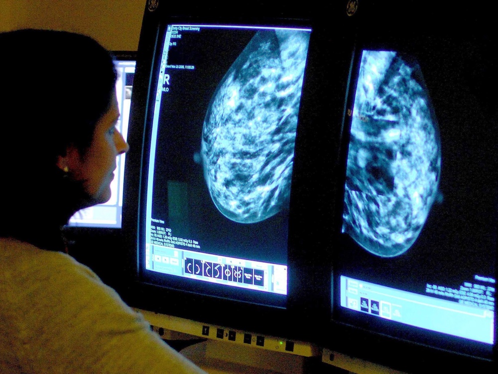 In breast cancer, the lymph nodes in the armpit are often the first place the disease spreads to (PA)