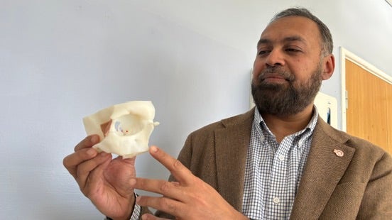 Consultant neurosurgeon Asim Sheikh holds a model of Mr Wood’s eye socket (Richard McCarthy/PA)