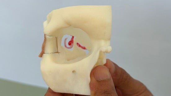 Experts at the hospital created a bespoke 3D printed model of the Mr Wood’s eye socket to allow doctors to prepare for the surgery (Richard McCarthy/PA)