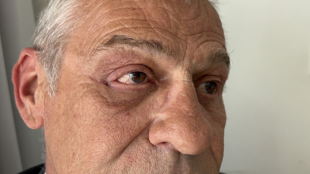 The UK-first operation displaced Mr Wood’s eye to treat a brain problem (Richard McCarthy/PA) (PA Wire)