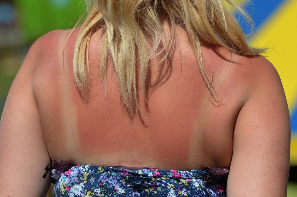 People sought advice for dealing with sunburn over the bank holiday (PA)
