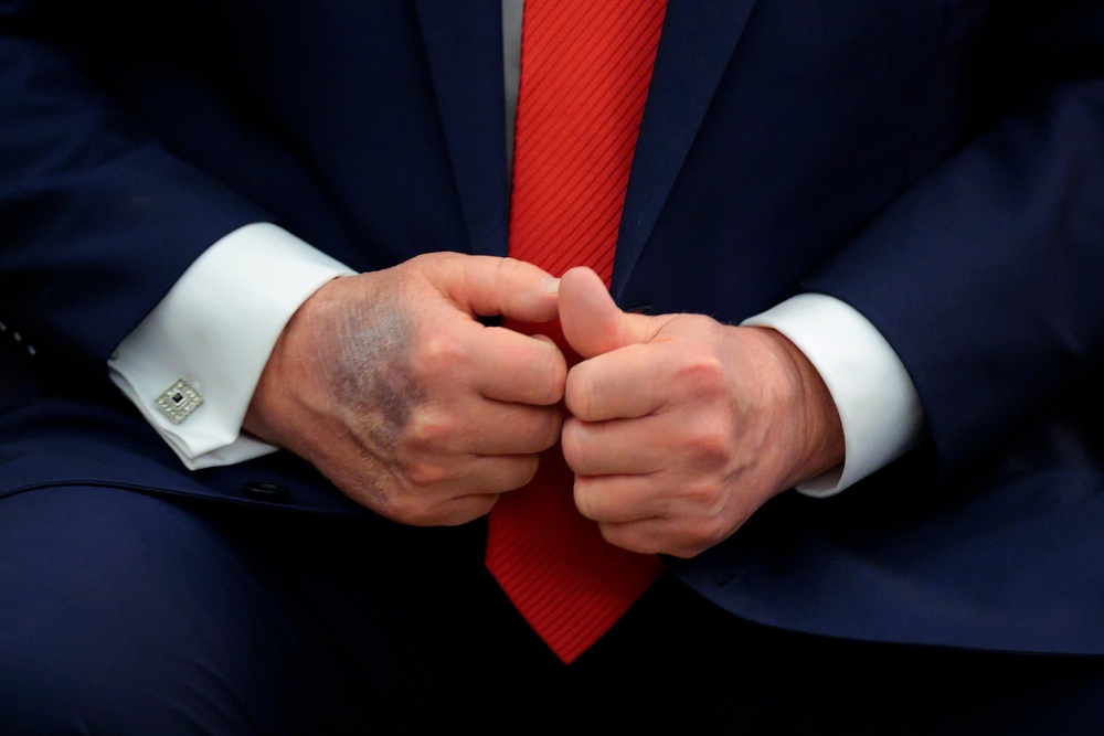 The report said Trump’s hand-bruising is consistent with ‘minor soft tissue irritation related to frequent handshaking’ while on aspirin therapy (Getty)