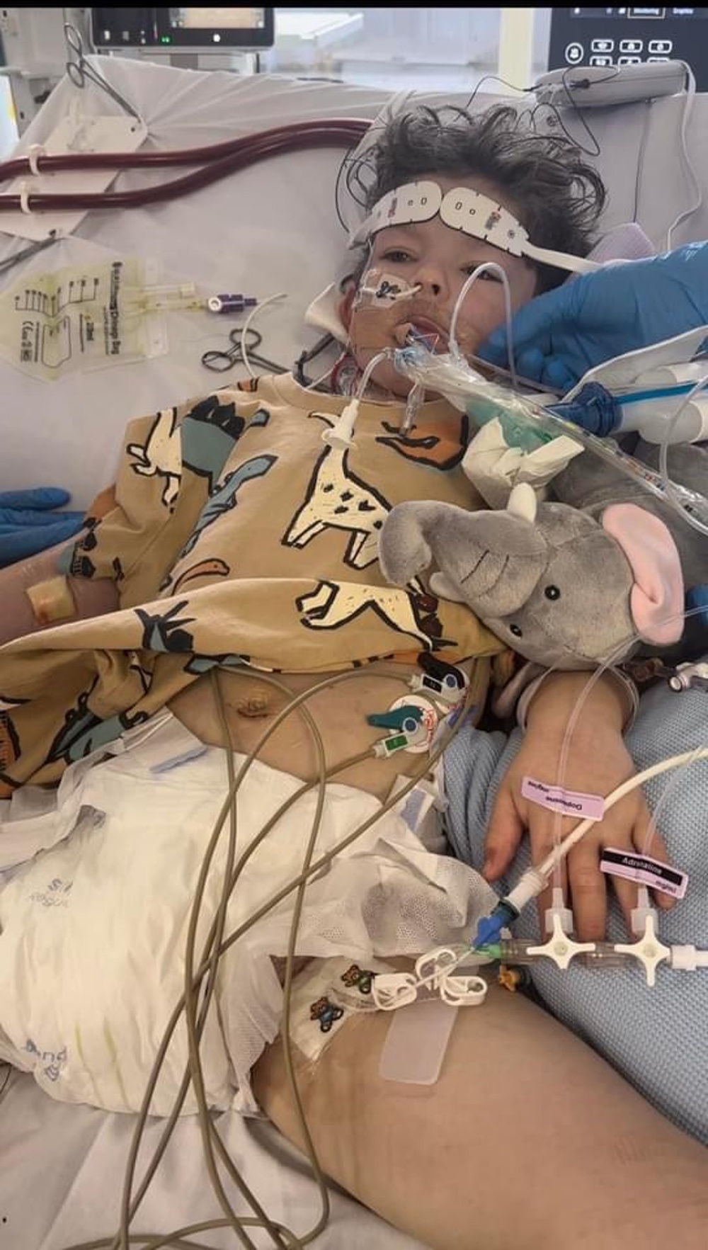 Rafi was put on an ECMO machine and dialysis (PA)
