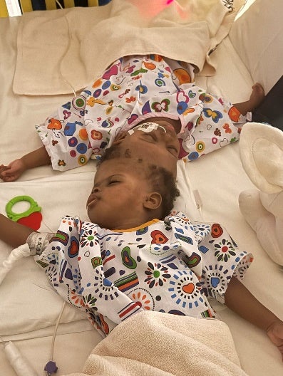 A UK charity, Gemini Untwined, has partnered with Abu Dhabi’s PureHealth to perform the nation’s first successful surgical separation of craniopagus twin girls, Nigerian born Mercy and Goodness, aged 19 months. (Gemini Untwined)